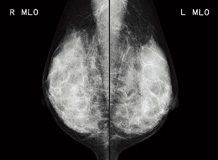 [Imagem] Aplicações de mamografia